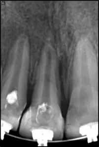 AUTO TRANSPLANTE GUIADO 7
