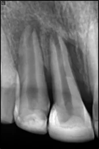 AUTOTRANSPLANTE GUIADO 6