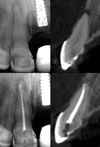 ENDODONCIA GUIADA POR COMPUTADOR 3