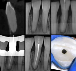 ENDODONCIA GUIADA POR CPMPUTADOR 2